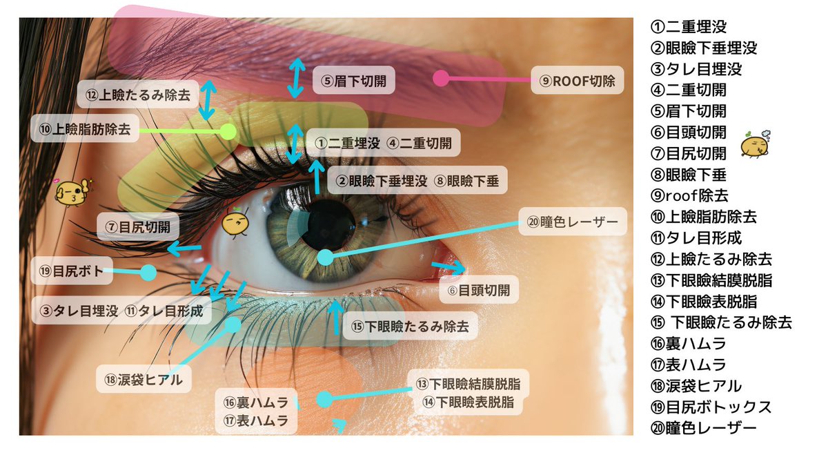 biyouiryou100's tweet photo. 目元整形の読み方

①二重埋没→ふたえまいぼつ
②眼瞼下垂→がんけんかすい
⑤眉下切開→まゆしたせっかい
⑥目頭切開→めがしらせっかい
⑦目尻切開→めじりせっかい
⑨roof除去→るーふじょきょ
⑩上瞼脂肪除去→うやまぶたしぼうじょきょ
⑬下眼瞼結膜脱脂→かがんけんけつまくだっし

間違い注意 https://t.co/7UpfXSzQQr
