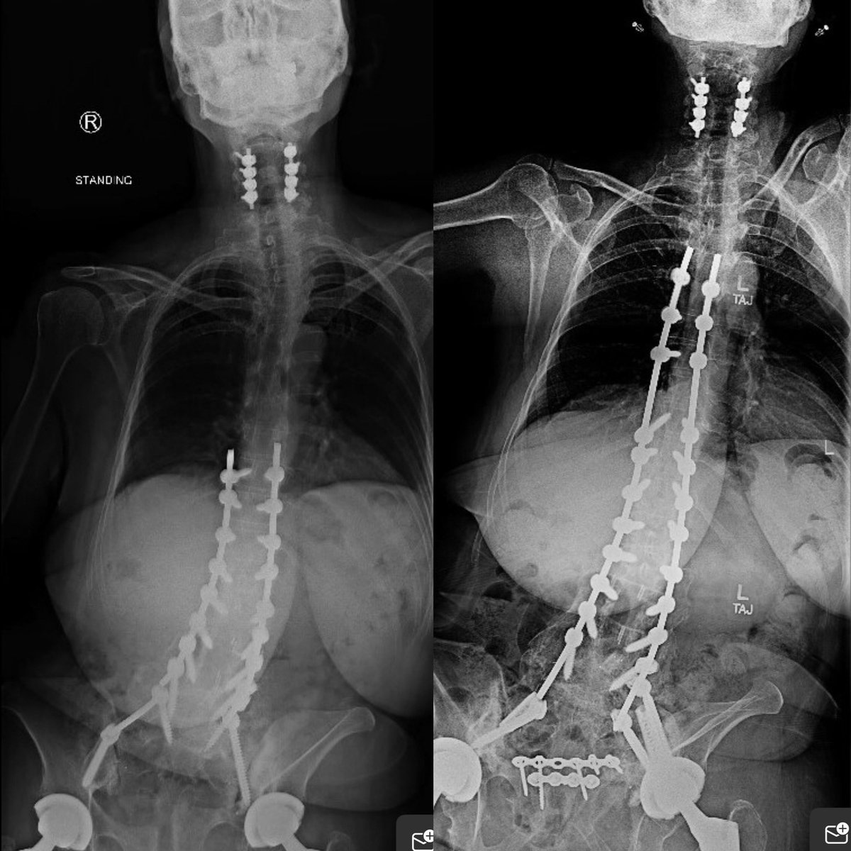 Andrew J. Grossbach, MD, FAANS tweet media