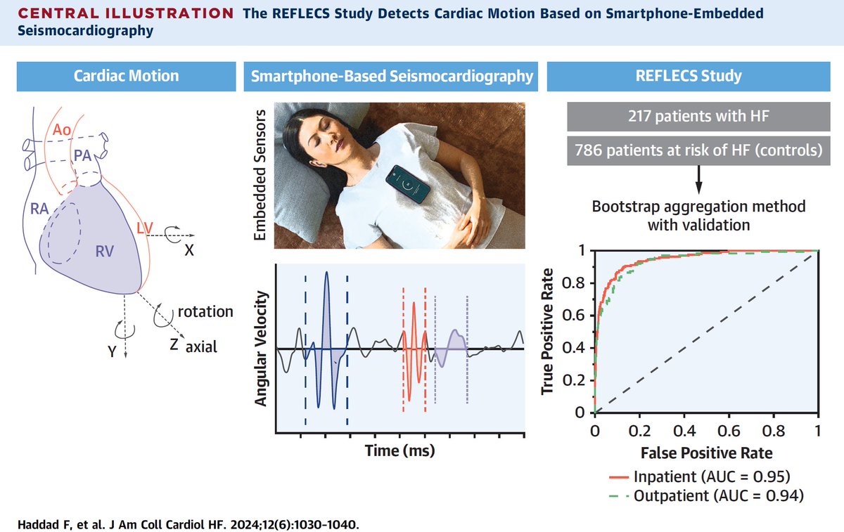Jeff Teuteberg (@jeffteuteberg) on Twitter photo What can't a📳do⁉️⁉️ <a href="/Stanford_HF/">Stanford Heart Failure, Cardiac Transplant and MCS</a>'s Francois Haddad & colleagues REFLECS study: use of smart-phone motion to assess for HF. <a href="/StanfordCVI/">Stanford CVI</a> <a href="/SCCR_Stanford/">Stanford Center for Clinical Research</a> <a href="/TheMahaf/">Kenneth Mahaffey</a> <a href="/JACCJournals/">JACC Journals</a> <a href="/ACCinTouch/">American College of Cardiology</a>
<a href="/EldrinL/">Eldrin Lewis</a> <a href="/KiranKhush1/">Kiran Khush</a> <a href="/euanashley/">euan ashley</a> <a href="/Stanford/">Stanford University</a>
jacc.org/doi/10.1016/j.… What can't a📳do⁉️⁉️ <a href="/Stanford_HF/">Stanford Heart Failure, Cardiac Transplant and MCS</a>'s Francois Haddad & colleagues REFLECS study: use of smart-phone motion to assess for HF. <a href="/StanfordCVI/">Stanford CVI</a> <a href="/SCCR_Stanford/">Stanford Center for Clinical Research</a> <a href="/TheMahaf/">Kenneth Mahaffey</a> <a href="/JACCJournals/">JACC Journals</a> <a href="/ACCinTouch/">American College of Cardiology</a>
<a href="/EldrinL/">Eldrin Lewis</a> <a href="/KiranKhush1/">Kiran Khush</a> <a href="/euanashley/">euan ashley</a> <a href="/Stanford/">Stanford University</a>
jacc.org/doi/10.1016/j.…