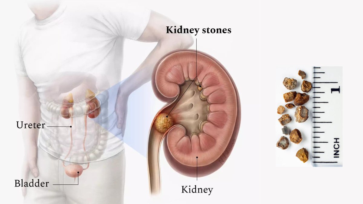 𝐊𝐢𝐝𝐧𝐞𝐲 𝐬𝐭𝐨𝐧𝐞𝐬 can cause severe pain, nausea, and vomiting. Drinking plenty of water and taking prescribed medications can help pass stones. 
Consult your urologist for treatment options. 
#KidneyStones #Urology #Kidneyhealth #nadeembinnusrat #urologycliniconline