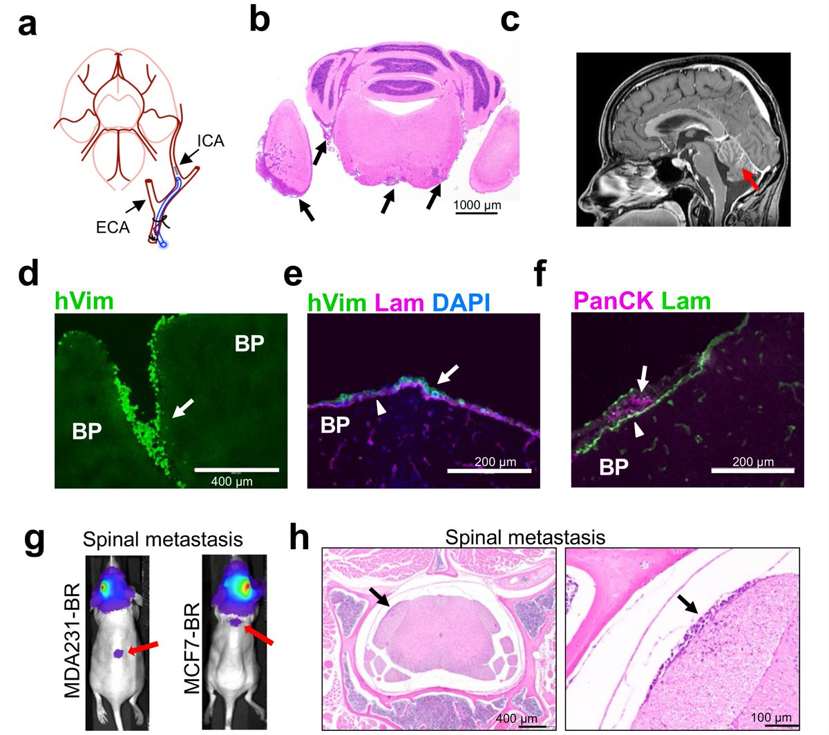 Congrats to Dr. Chernikova and <a href="/ARodrigues121/">Adrian Rodrigues, MD</a> on their cover article outlining our work on #breastcancer leptomeningeal disease, a challenging subtype of #brainmetastases. Targeting cancer migration may help to improve patient outcomes. <a href="/JNeurooncol/">Journal of Neuro-Oncology</a> 
bit.ly/45PeZn7