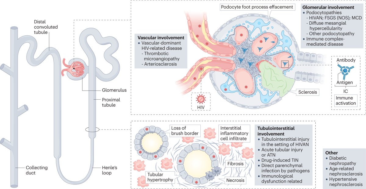 Pathological classification of HIV-associated kidney disease.

go.nature.com/3zwupk0