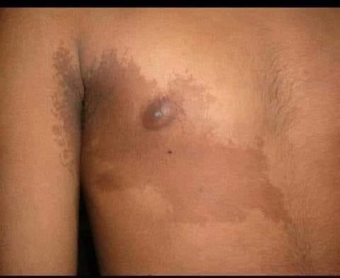 hemo_shk's tweet photo. #spot
What is the diagnosis?
#sign
#MEDHM
#MedX
@IhabFathiSulima https://t.co/RPGXTxr2s8