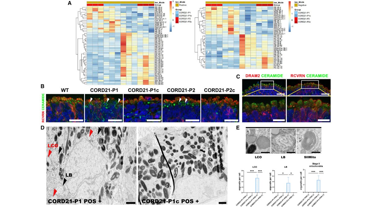 stemcellreports's tweet photo. New #retinalorganoid research! Retinal cells derived from patients with DRAM2-dependent CORD21 dystrophy exhibit key lysosomal enzyme deficiency and lysosomal content accumulation #DRAM2 #lysosomes

https://t.co/nuePXeqbXB

@UniofNewcastle @ISSCR @CellPressNews @MartinPeraJAX https://t.co/hNOrcJs3yk