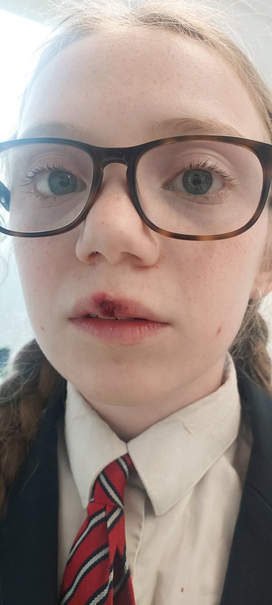 Wattsit01's tweet photo. When your daughter sustains THIS injury in @asda and you're told there is no 1st aider, no duty manager and no accident report form to fill in and they don't show any interest in mopping up her blood from the floor... a trip to A&amp;E and some glue and steri strips later she's OK🙁 https://t.co/J90nULDcp2