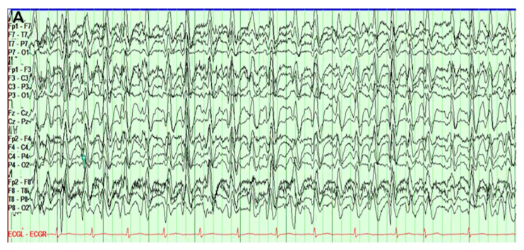 1/
A 72 yo W pw urosepsis.  She is started on ceftriaxone. Her white count downtrends, pressors are weaned. Hemodynamically she’s doing better.

Except she continues to be altered.

EEG is ordered and shows this! 

A #continuumcase about … a continuum: 

An ictal-interictal one