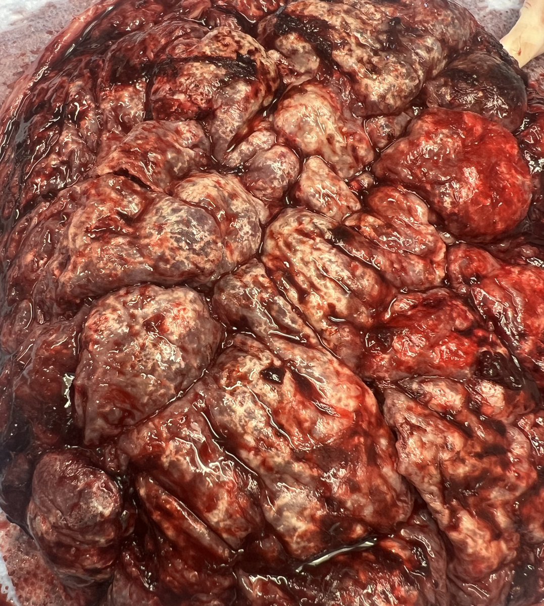 OliviaAscp's tweet image. When grossing placentas, I use the phrase “increased stippled calcifications” to describe a maternal surface that looks like this #education #pathology