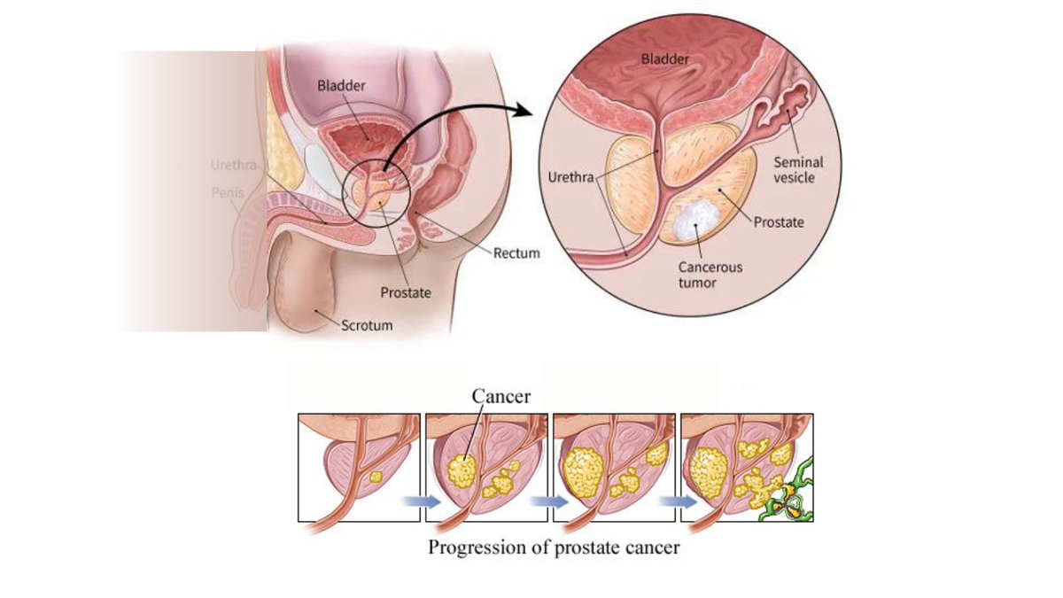 𝐏𝐫𝐨𝐬𝐭𝐚𝐭𝐞 𝐜𝐚𝐧𝐜𝐞𝐫 can cause urinary issues and erectile dysfunction. Early detection through PSA tests and regular check-ups is crucial for effective treatment. #ProstateCancer #Urology #Health #urologistinpakistan #nadeembinnusrat #Urologist #drnadeemurologist