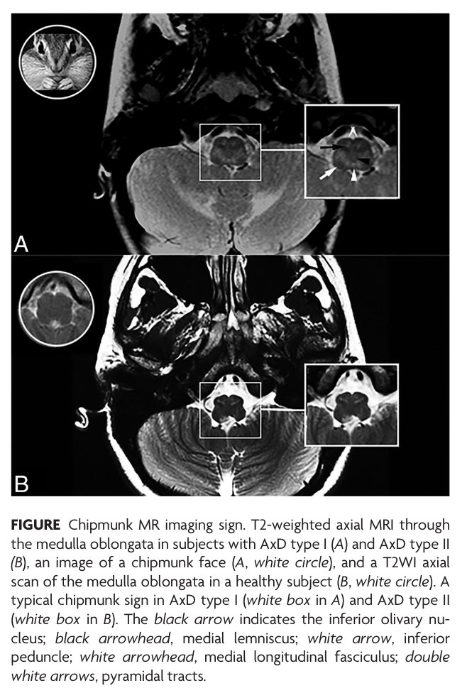 "Brainstem Chipmunk Sign: A Diagnostic Imaging Clue across All Subtypes of Alexander Disease"

doi.org/10.3174/ajnr.A…

#FellowsJournalClub
