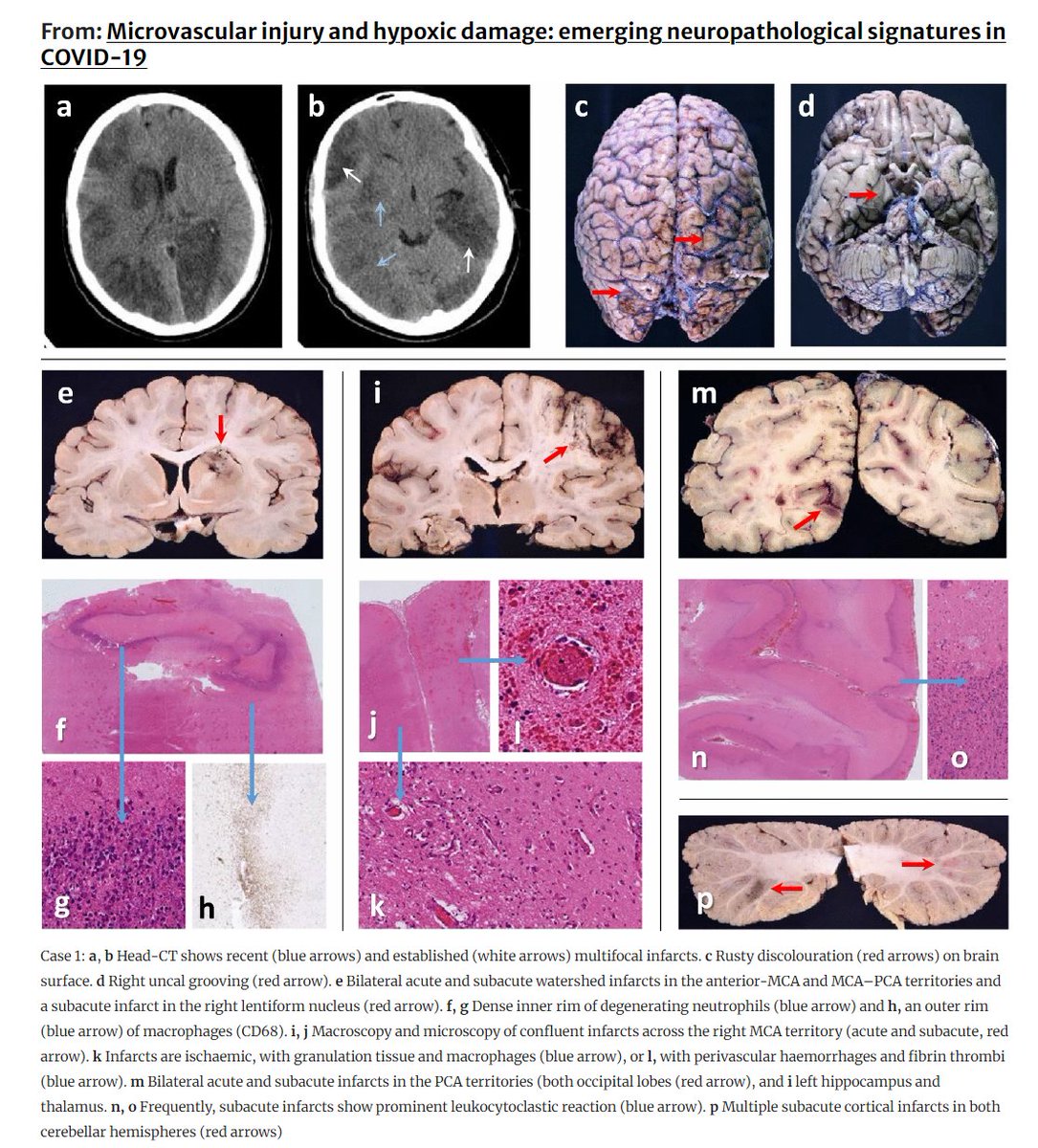 DaniBeckman's tweet photo. Imagine trying to normalize this. This brain is from a man in his fifties who suffered from cardiac arrest after Covid-19 (no-vax). Most people don't die of Covid, so we can't really look at their brains. Does that mean #neuroCovid is not real? For many people, yes. 🙄