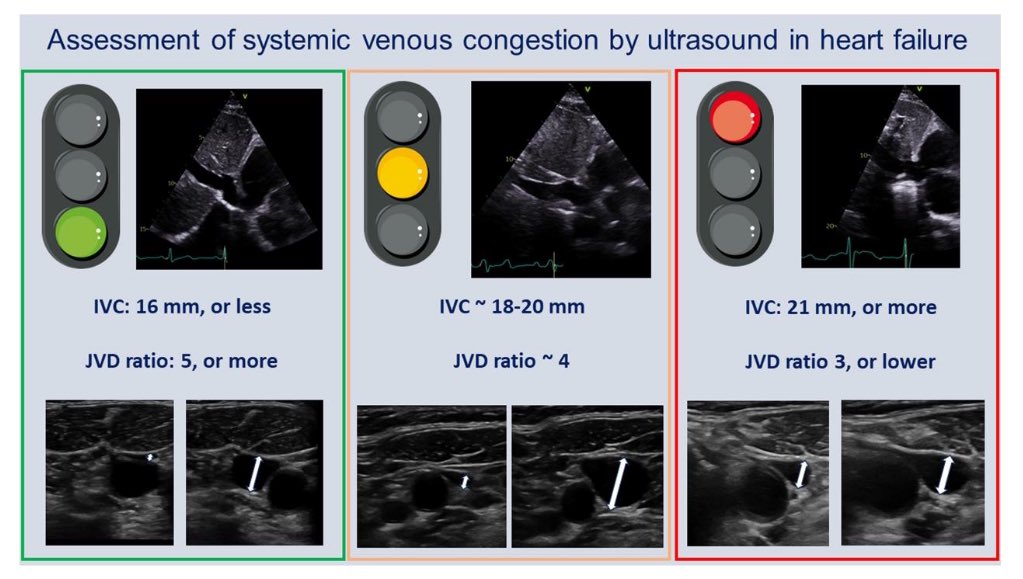 💔Cómo #Diagnosticar y Tratar la #Congestión Venosa en la Insuficiencia Cardíaca 💧

- La evaluación por niveles de congestión 🛑🟡🟢 se puede evaluar  observando la dilatación de la vena cava inferior (VCI) y calculando la relación entre el diámetro de la vena yugular interna