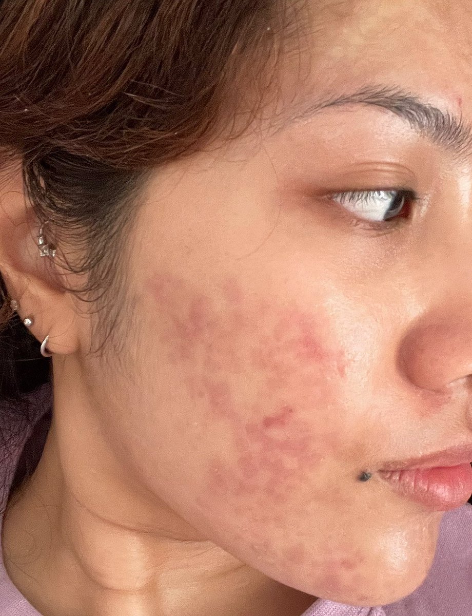 I ada tengok tiktok, kalau skincare tak lut, then something's wrong with your gut health. And yes. That's the reason why muka I breakout teruk.

Lepas consume probiotics after a month, there's a huge difference on my skin and body (cont)