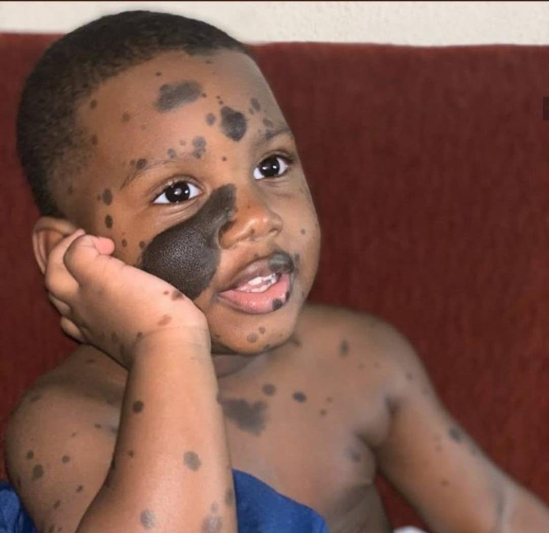 If his skin condition doesn't bother you, then repost and leave a heart 💙