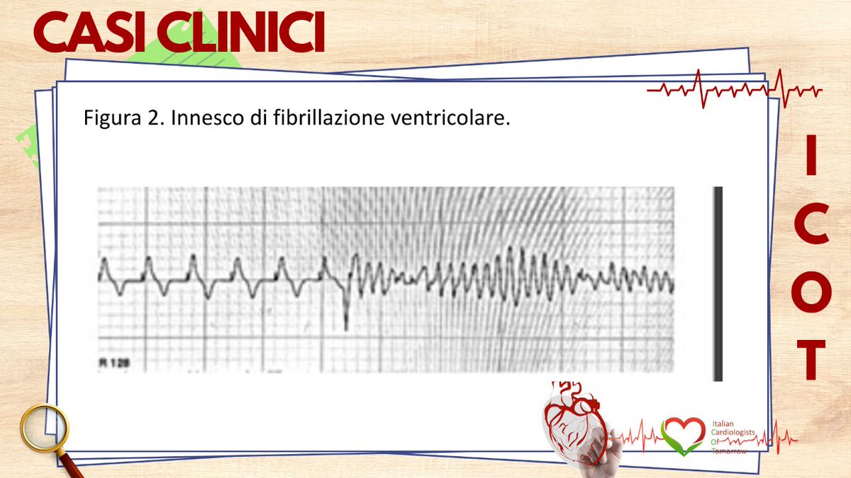 Italian Cardiologists Of Tomorrow (@italian_cot) on Twitter photo ICOT Clinical Case of the Week: rubrica a cura di <a href="/DomitillaGenti1/">Domitilla Gentile</a>
ed Enrico Spinoni
🫀Diagnosi retrospettiva di sindrome di Brugada in corso di storm aritmico da sindrome coronarica acuta: incertezze diagnostico-terapeutiche
Università di Milano
📍Presto sul nostro sito ICOT Clinical Case of the Week: rubrica a cura di <a href="/DomitillaGenti1/">Domitilla Gentile</a>
ed Enrico Spinoni
🫀Diagnosi retrospettiva di sindrome di Brugada in corso di storm aritmico da sindrome coronarica acuta: incertezze diagnostico-terapeutiche
Università di Milano
📍Presto sul nostro sito