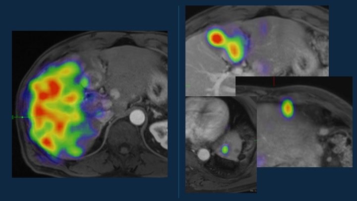 Zach Berman MD (@ztberman) on Twitter photo Using pressure catheters (<a href="/terumoisuk/">Terumo Interventional Systems</a>, <a href="/EmbolxInc/">Embolx</a>, <a href="/TriSalusLifeSci/">TriSalus Life Sciences</a>) can really change lobar deliveries of Y90. Tx SPECT (same pt)-Right with end hole, Left with pressure cath. Both resin, partition dosimetry, G3 metNET. 📉 liver dose, 📈 tumor dose. The Future of lobar #TARE? Using pressure catheters (<a href="/terumoisuk/">Terumo Interventional Systems</a>, <a href="/EmbolxInc/">Embolx</a>, <a href="/TriSalusLifeSci/">TriSalus Life Sciences</a>) can really change lobar deliveries of Y90. Tx SPECT (same pt)-Right with end hole, Left with pressure cath. Both resin, partition dosimetry, G3 metNET. 📉 liver dose, 📈 tumor dose. The Future of lobar #TARE?