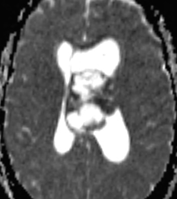 In a central neurocytoma, the areas of enhancement correspond to regions of restricted diffusion and presumed hypercellularity on DWI and ADC (shown here). A coronal T2 MRI can help detect tumor attachment site. Learn more here: zurl.co/9RbK  
#MedTwitter #Neurosurgery