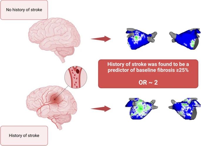 Abdel Hadi (@ahelhajjar) on Twitter photo Excited to share our new manuscript! History of stroke predicts higher left atrial fibrosis in persistent AF patients <a href="/TulaneTriad/">TulaneTRIAD</a> now published <a href="/nmarrouche/">Nassir Marrouche</a> <a href="/JICE_EP/">JICE</a> <a href="/CCF_IMCHIEFS/">Cleveland Clinic IM</a> <a href="/Mud_Fud/">Richard M. Wardrop III, MD, PhD, MACP, SFHM, FAAP</a>
doi.org/10.1007/s10840… Excited to share our new manuscript! History of stroke predicts higher left atrial fibrosis in persistent AF patients <a href="/TulaneTriad/">TulaneTRIAD</a> now published <a href="/nmarrouche/">Nassir Marrouche</a> <a href="/JICE_EP/">JICE</a> <a href="/CCF_IMCHIEFS/">Cleveland Clinic IM</a> <a href="/Mud_Fud/">Richard M. Wardrop III, MD, PhD, MACP, SFHM, FAAP</a>
doi.org/10.1007/s10840…