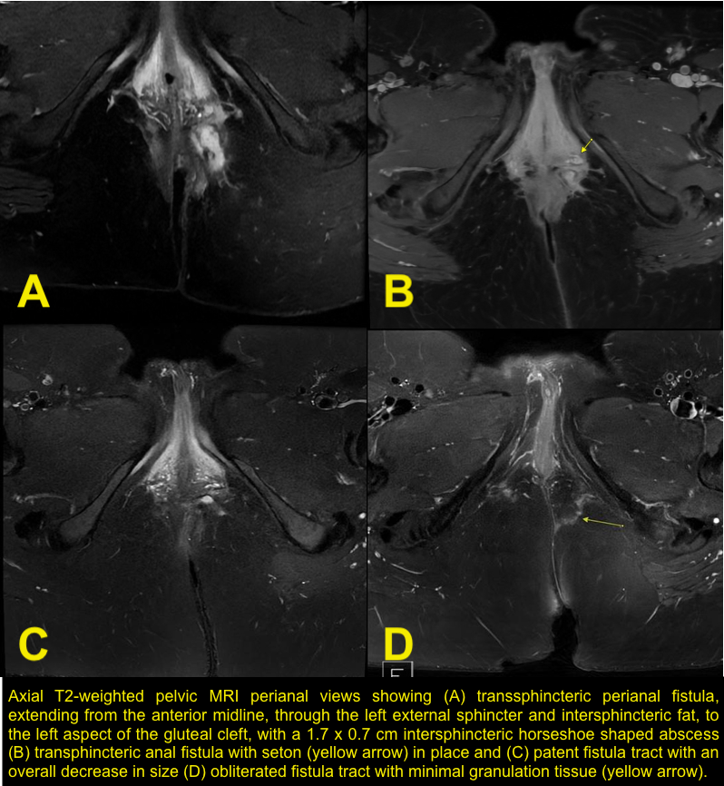Kaiser O'Sahil Sadiq (@kaisersadiq) on Twitter photo The first report of #perianal #fistula in #BehçetsDisease successfully treated with autologous #stemcell fat grafting published in <a href="/IBDJournals/">IBDJournal & CC360</a>. Thank you <a href="/DrE_UCSD/">Samuel Eisenstein</a>, <a href="/NELopezMD/">Nicole Lopez</a>, <a href="/BolandBrigid/">Brigid Boland</a>, Dr. Marek Dobke, and <a href="/UCSDsurgery/">UC San Diego Surgery</a>! #IBD #ColorectalSurgery
doi.org/10.1093/ibd/iz… The first report of #perianal #fistula in #BehçetsDisease successfully treated with autologous #stemcell fat grafting published in <a href="/IBDJournals/">IBDJournal & CC360</a>. Thank you <a href="/DrE_UCSD/">Samuel Eisenstein</a>, <a href="/NELopezMD/">Nicole Lopez</a>, <a href="/BolandBrigid/">Brigid Boland</a>, Dr. Marek Dobke, and <a href="/UCSDsurgery/">UC San Diego Surgery</a>! #IBD #ColorectalSurgery
doi.org/10.1093/ibd/iz…