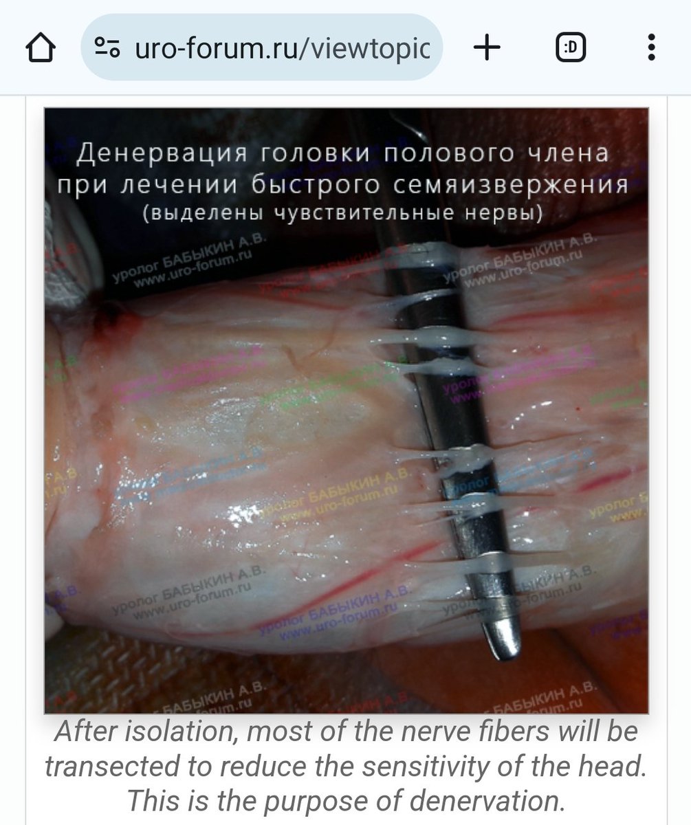low_cut's tweet photo. Has anyone done a #denervation of the penis head? If yes, what's your experience? https://t.co/zgLnXaFXih