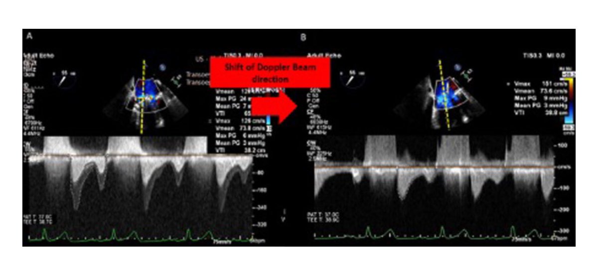 🩸Double envelope spectral profile can be challenging to interpret during m-TEER cases. 

🩸 Expert believe not an artifact rather phenomenon of complex flow dynamics. 
- Inner Doppler signal is the one that correlates with invasive LA pressures in cath lab. 

🩸 The closer the
