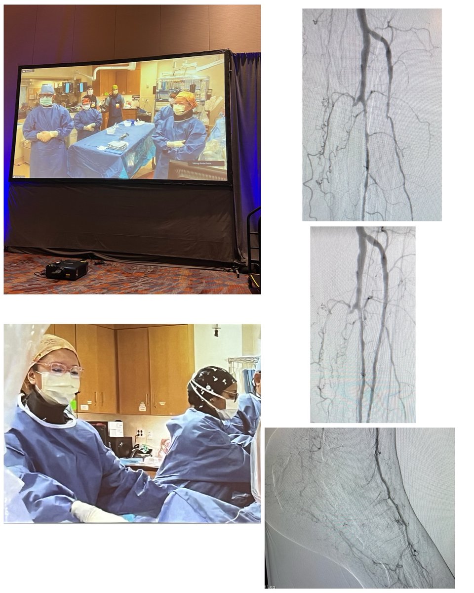 Yulanka Castro, M.D. (@yscastromd) on Twitter photo Wonderful time during our infrapopliteal CLTI live case for #CVI2024 from <a href="/HarringtonHVI/">UH Harrington Heart & Vascular Institute</a> - showcasing use of vessel prep and scaffold for BTK disease. Great work by amazing staff and great panel discussion. @JunLiMD <a href="/shishem/">Mehdi Shishehbor, DO</a> <a href="/thammad2010/">Tarek A. Hammad</a> @mcbunte <a href="/CarlosMenaYale/">Carlos Mena</a> Wonderful time during our infrapopliteal CLTI live case for #CVI2024 from <a href="/HarringtonHVI/">UH Harrington Heart & Vascular Institute</a> - showcasing use of vessel prep and scaffold for BTK disease. Great work by amazing staff and great panel discussion. @JunLiMD <a href="/shishem/">Mehdi Shishehbor, DO</a> <a href="/thammad2010/">Tarek A. Hammad</a> @mcbunte <a href="/CarlosMenaYale/">Carlos Mena</a>
