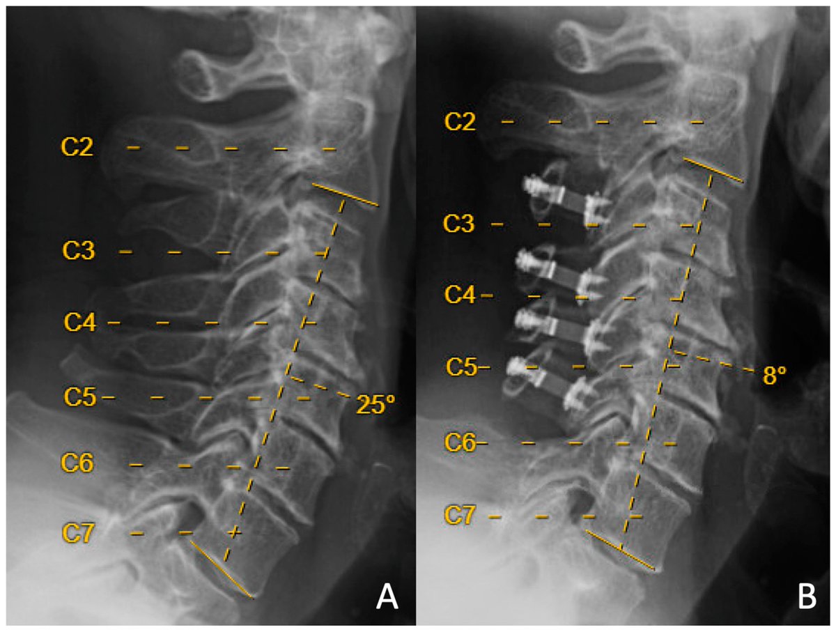 Amanda Du (@amanda_du1) on Twitter photo Welcome to the article "Multilevel Laminoplasty for CSM: Is C3 Laminectomy Better Than C3 Laminoplasty at the Superior Vertebra?" published in <a href="/JCM_MDPI/">JCM MDPI</a>.
👥by <a href="/MohamedMackiMD/">Mohamed Macki, MD MPH</a> et al. <a href="/MeadeMedTweets/">Seth Meade</a>
🔍Full Text: mdpi.com/2594030
#SpineSurgery #patients #cervical Welcome to the article "Multilevel Laminoplasty for CSM: Is C3 Laminectomy Better Than C3 Laminoplasty at the Superior Vertebra?" published in <a href="/JCM_MDPI/">JCM MDPI</a>.
👥by <a href="/MohamedMackiMD/">Mohamed Macki, MD MPH</a> et al. <a href="/MeadeMedTweets/">Seth Meade</a>
🔍Full Text: mdpi.com/2594030
#SpineSurgery #patients #cervical