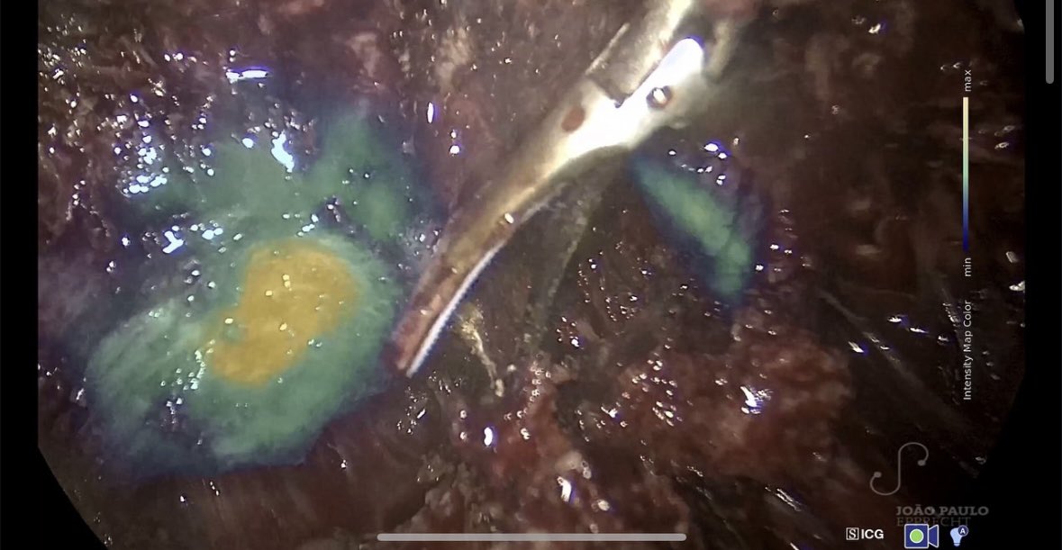 EndoGlow's tweet photo. In this video &amp; photos, the GreenEgg from @EndoGlow is used with the Karl Storz Rubina system during the resection of a rectum-vaginal septum endometriosis nodule. https://t.co/yJ2hTYN8uN