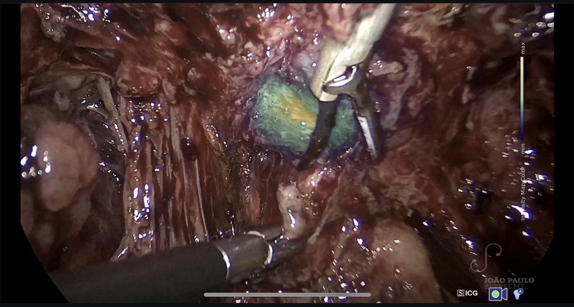 EndoGlow's tweet photo. In this video &amp; photos, the GreenEgg from @EndoGlow is used with the Karl Storz Rubina system during the resection of a rectum-vaginal septum endometriosis nodule. https://t.co/yJ2hTYN8uN