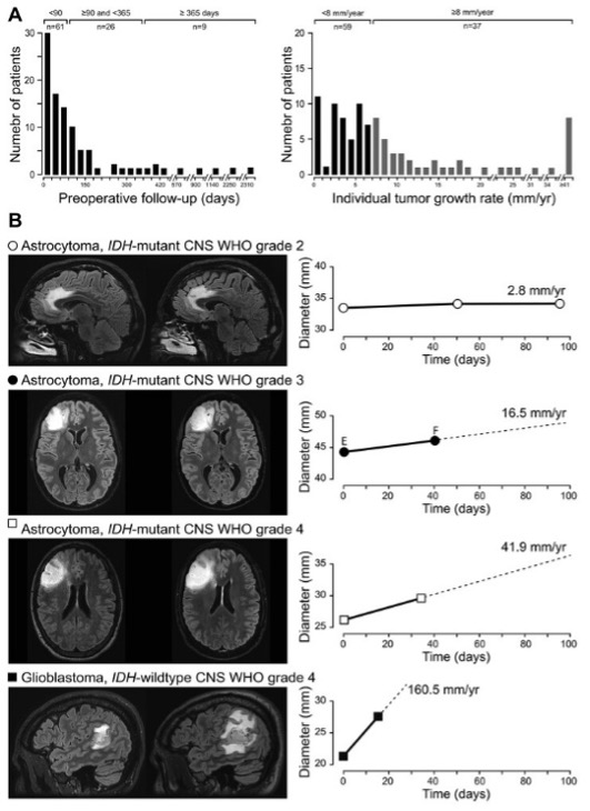 Inserm Paris 5 Ipnp (@insermu1266) on Twitter photo Leclerc et al (team Oppenheim/Pallud) <a href="/IPNP/">IP=NP</a> show that spontaneous radiographic tumor growth rates should be used as tool to screen tumor aggressiveness of adult-type diffuse gliomas without 1p19q codeletion. pubmed.ncbi.nlm.nih.gov/38301236/
<a href="/inserm/">Inserm</a> <a href="/GhuParis/">GHU Paris Psy-Neuro</a> #glioma <a href="/neurosurgery/">Neurosurgery</a> Leclerc et al (team Oppenheim/Pallud) <a href="/IPNP/">IP=NP</a> show that spontaneous radiographic tumor growth rates should be used as tool to screen tumor aggressiveness of adult-type diffuse gliomas without 1p19q codeletion. pubmed.ncbi.nlm.nih.gov/38301236/
<a href="/inserm/">Inserm</a> <a href="/GhuParis/">GHU Paris Psy-Neuro</a> #glioma <a href="/neurosurgery/">Neurosurgery</a>