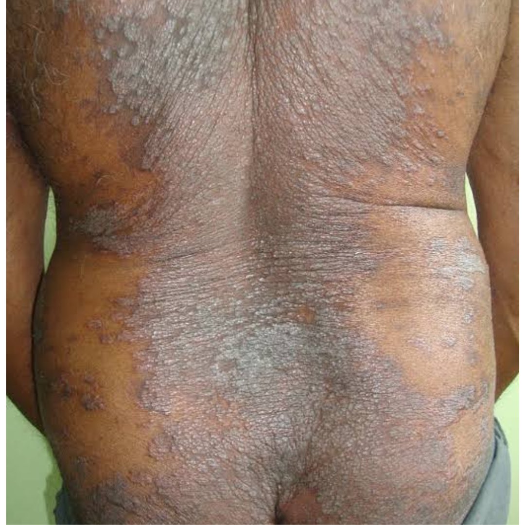 celebritypharm's tweet photo. Psoriasis is another skin condition that we need to talk about 

What are the causes of Psoriasis?

Is it contagious? 

Can it be cured?

Come with me 👇 https://t.co/qRk2Cyt3ST