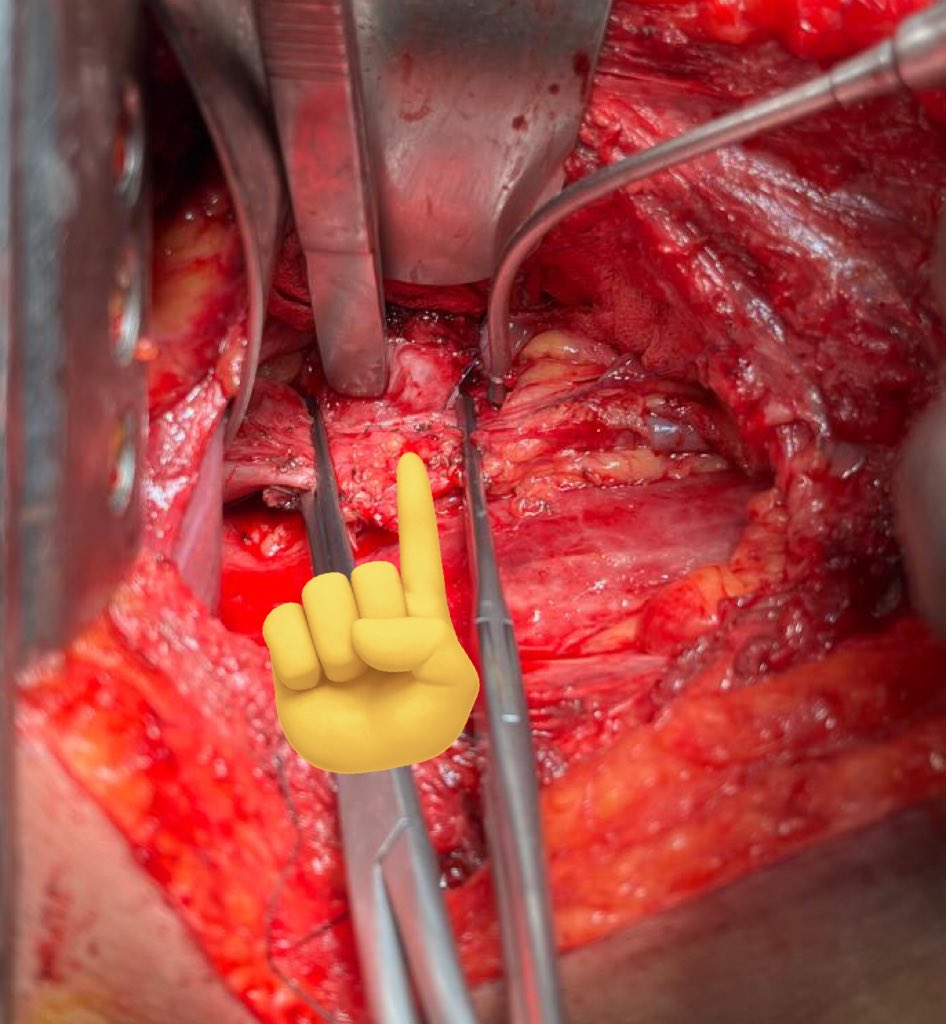 drram90's tweet photo. Graphic warning!!!!

It was an interesting case today!
Renal cell carcinoma with a solitary hilar lymph node densely adhered to IVC wall!
Resected en bloc with IVC reconstruction!
#RadicalNephrectomy 
#SurgX https://t.co/y3ZRYw7fBT