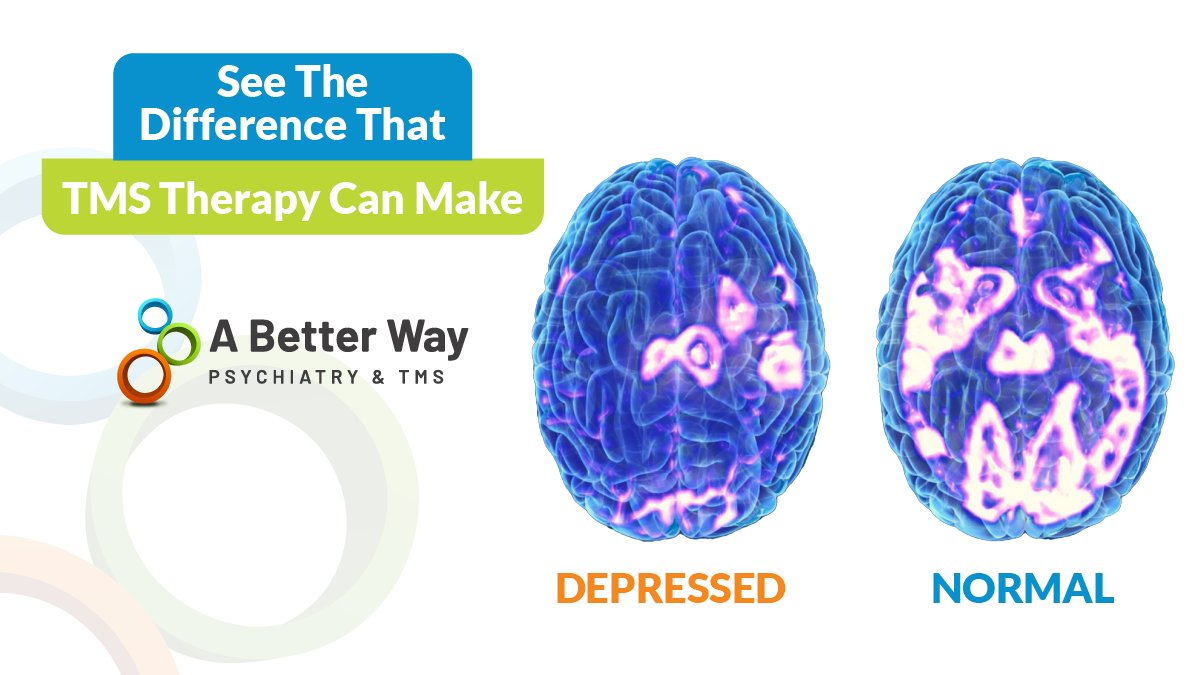 abetterwaytms's tweet photo. TMS therapy can be highly effective for individuals who are considered to have ‘treatment resistant’ depression. Schedule a free consultation at any of our locations to learn how TMS can help you: https://t.co/lvBRx6uqs8
#TMS #TMSTherapy #ABetterWay #TMSprovider #mentalhealth https://t.co/5DViuBrwb8