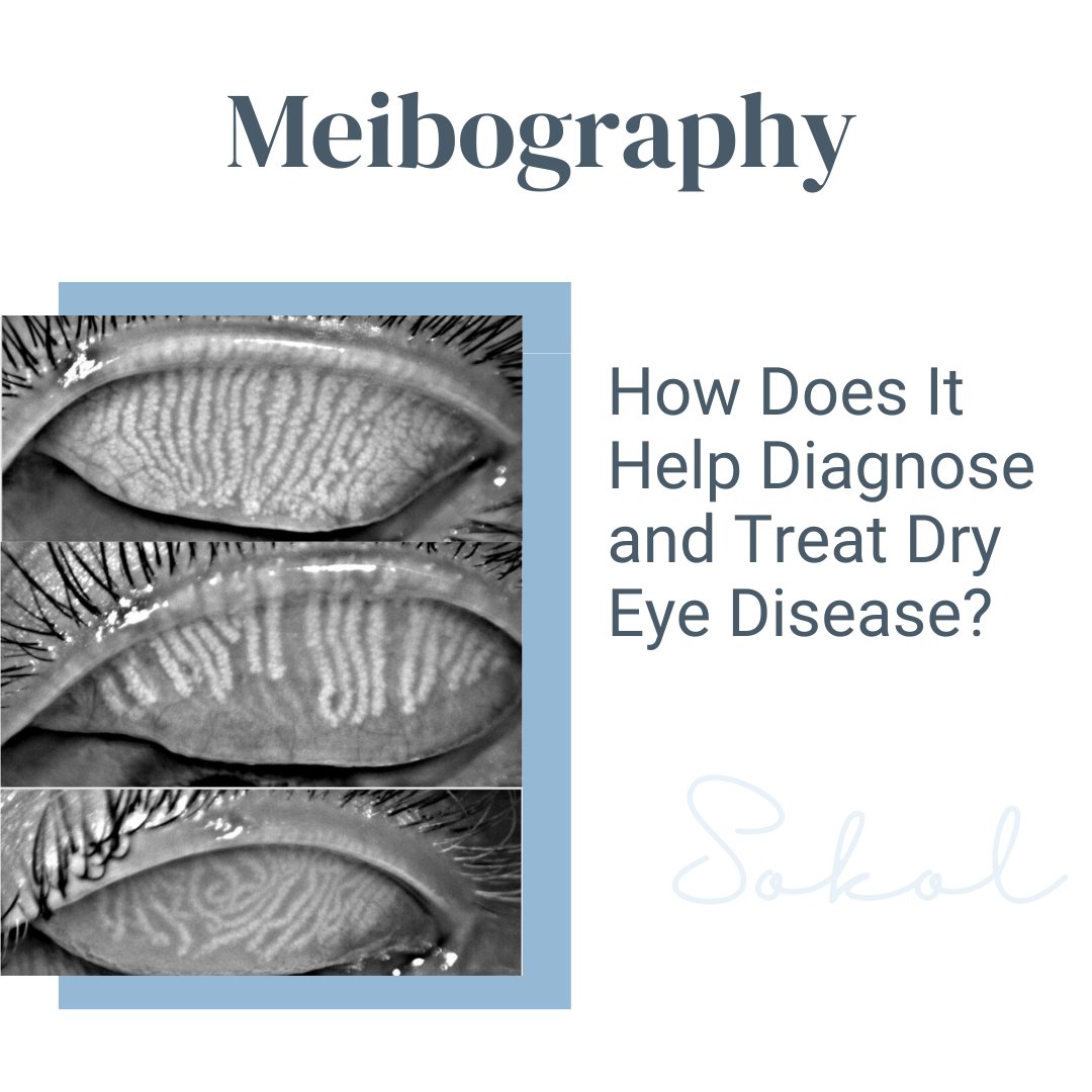 sokoleyecare's tweet image. Meibography is advanced imaging that shows the condition of your meibomian glands, which produce the oil that prevents tear evaporation. Accurate diagnosis = better treatment! Schedule your Dry Eye Consultation today! #Meibography #DryEyeDiagnosis #SokolEyecare #MadisonWI