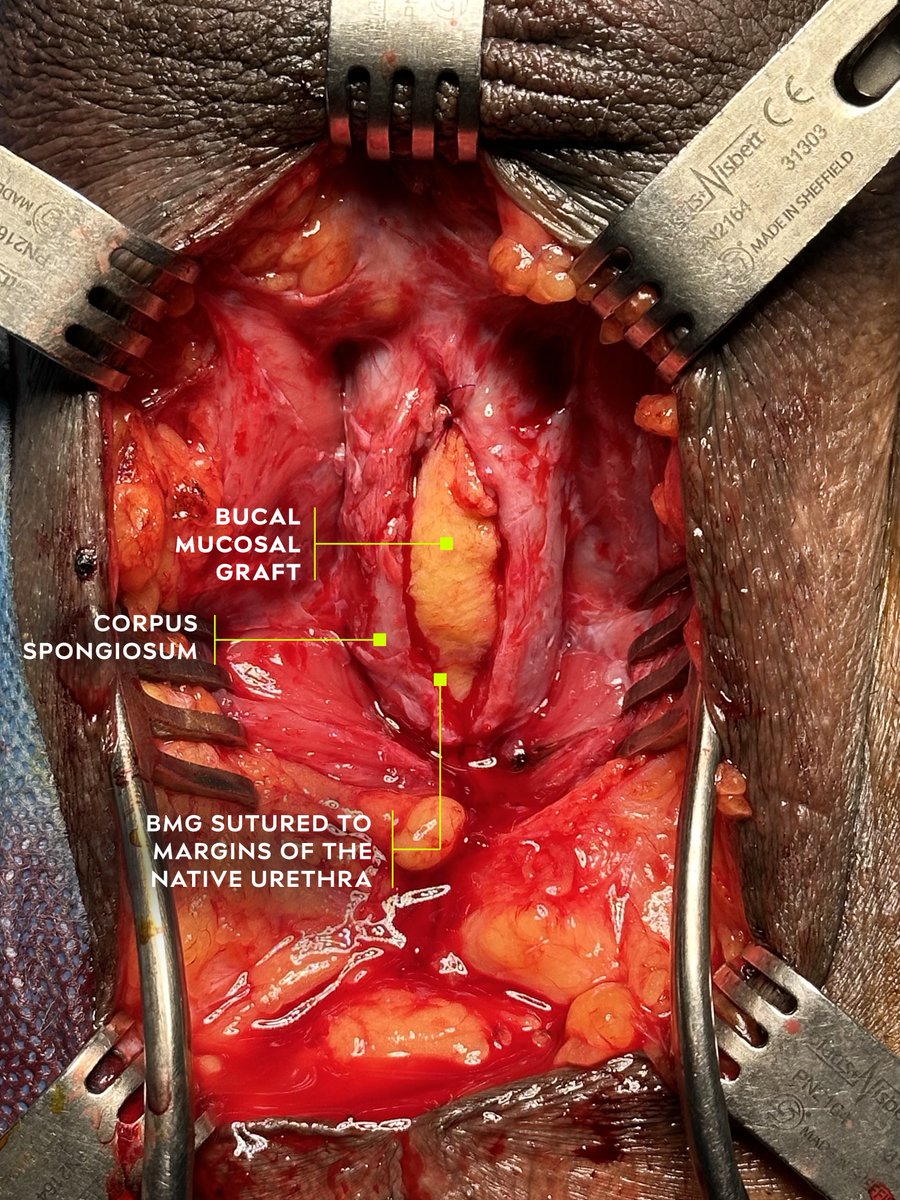 chica de uro✨ (@lachicadeuro) on Twitter photo BMG VENTRAL ONLAY Urethroplasty ⬇️
◽️First described by Morey and McAninch in 1996📚
Indications:
◽️Midbulbar and proximal bulbar strictures | Obese patients
◽️Post TURP strictures
◽️Not suitable for traumatic bulbar urethral strictures
Advantages
✅Requires less urethral BMG VENTRAL ONLAY Urethroplasty ⬇️
◽️First described by Morey and McAninch in 1996📚
Indications:
◽️Midbulbar and proximal bulbar strictures | Obese patients
◽️Post TURP strictures
◽️Not suitable for traumatic bulbar urethral strictures
Advantages
✅Requires less urethral