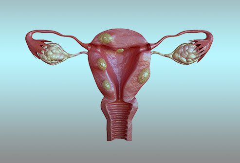 emergencyres's tweet photo. Uterine fibroids growths made of muscle and tissue that form in or on the wall in uterus. These growths are usually not cancerous and are the most common noncancerous tumor in women and people assigned female at birth.
Visit us: https://t.co/ar7XoKqsDG
#tissue #cancerous #pain https://t.co/aB7bGEFptz