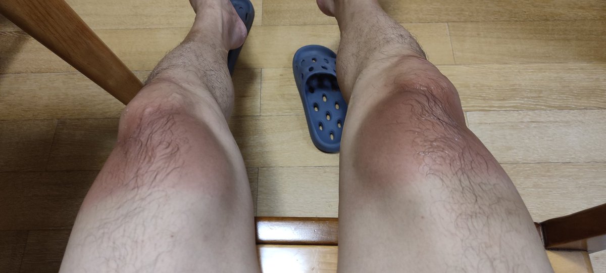 cnpenben's tweet photo. 骑电动车晒成这样了。 https://t.co/GDqIj9PbvL