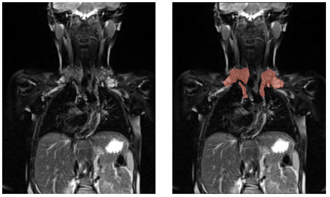 Hanna_Paulaluap's tweet photo. 🚀🩻 Exciting collaboration alert! The IDEA Lab  @aibe_fau @UniFAU and pediatric specialists at University Hospital Erlangen (#UKER) joined forces to develop a new AI tool for assessing Fontan circulation complications in children with CHD.  🏥🖥️
@BorderlessSci @BernhardKainz1 https://t.co/4487CWkl0U