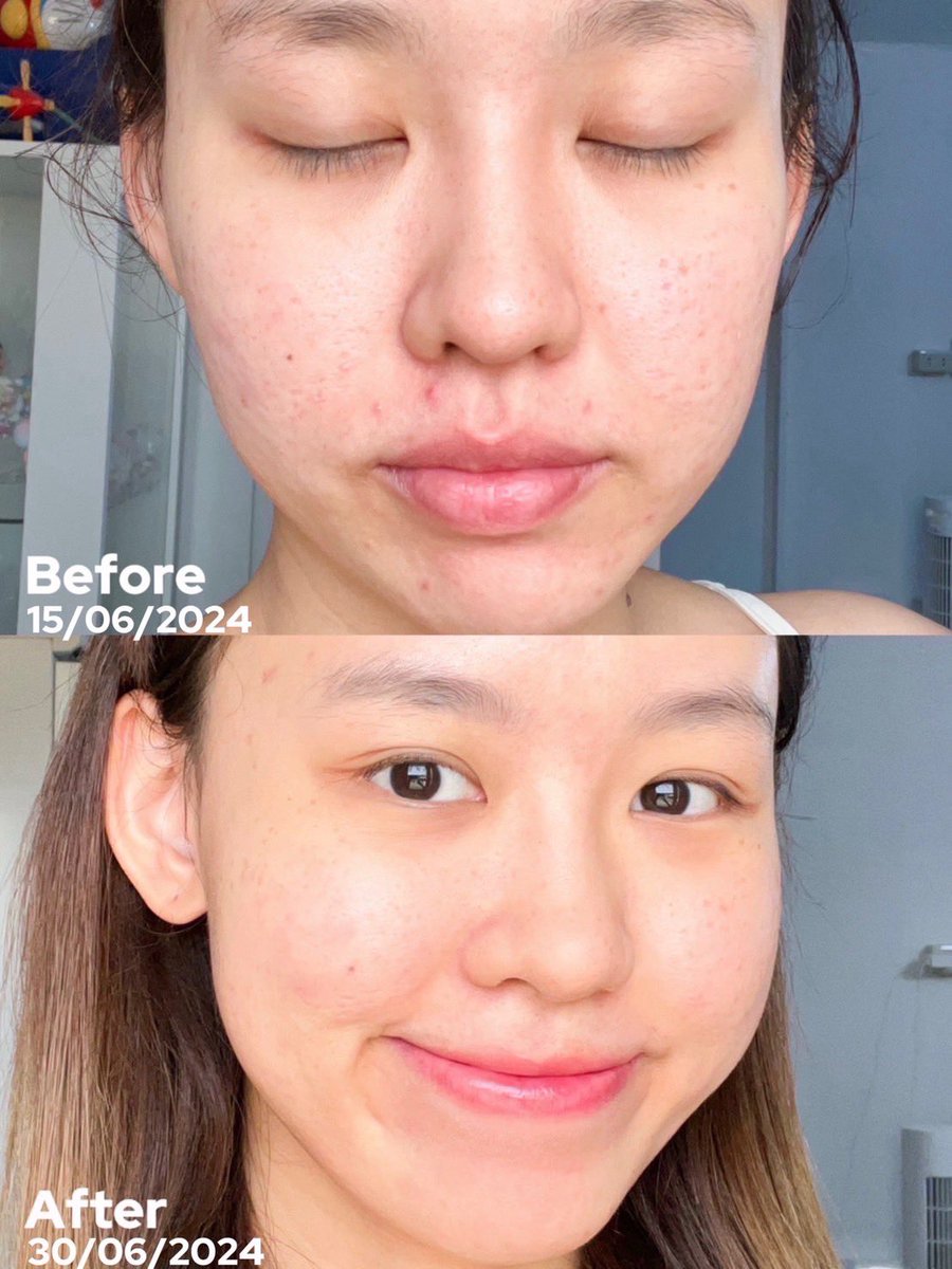 Naitong9's tweet photo. ช่วงสิวบุกต้องยกให้ Eucerin SOS Serum กู้สิวหายแบบข้ามคืนจริง ๆ ไม่ว่าจะสิวขึ้นเพราะแพ้ ประจำเดือนมา ก็เอาอยู่หมด ส่วนผสมคือถูกต้อง ช่วยลดสิว ลดอักเสบ เพราะมีสารลดอั��เสบ X2 ทั้ง Licochalcone A และ Panthenol และช่วยลดความมัน นี่ใช้แล้วเห็นชัดเลยว่าสิวเริ่มยุบไวใน 8 ชั่วโมง !! ไม่มีแอล น้ำหอม และพาราเบนด้วยน้า ลูกรักตลอดไป แพทซื้อจาก Watsons ออนไลน์มาน้า  📌https://t.co/U8yiCG9ZJi    

#EucerinThailand #EucerinSOSserum #EucerinSOSserumจัดการสิวเร่งด่วนใน8ชม