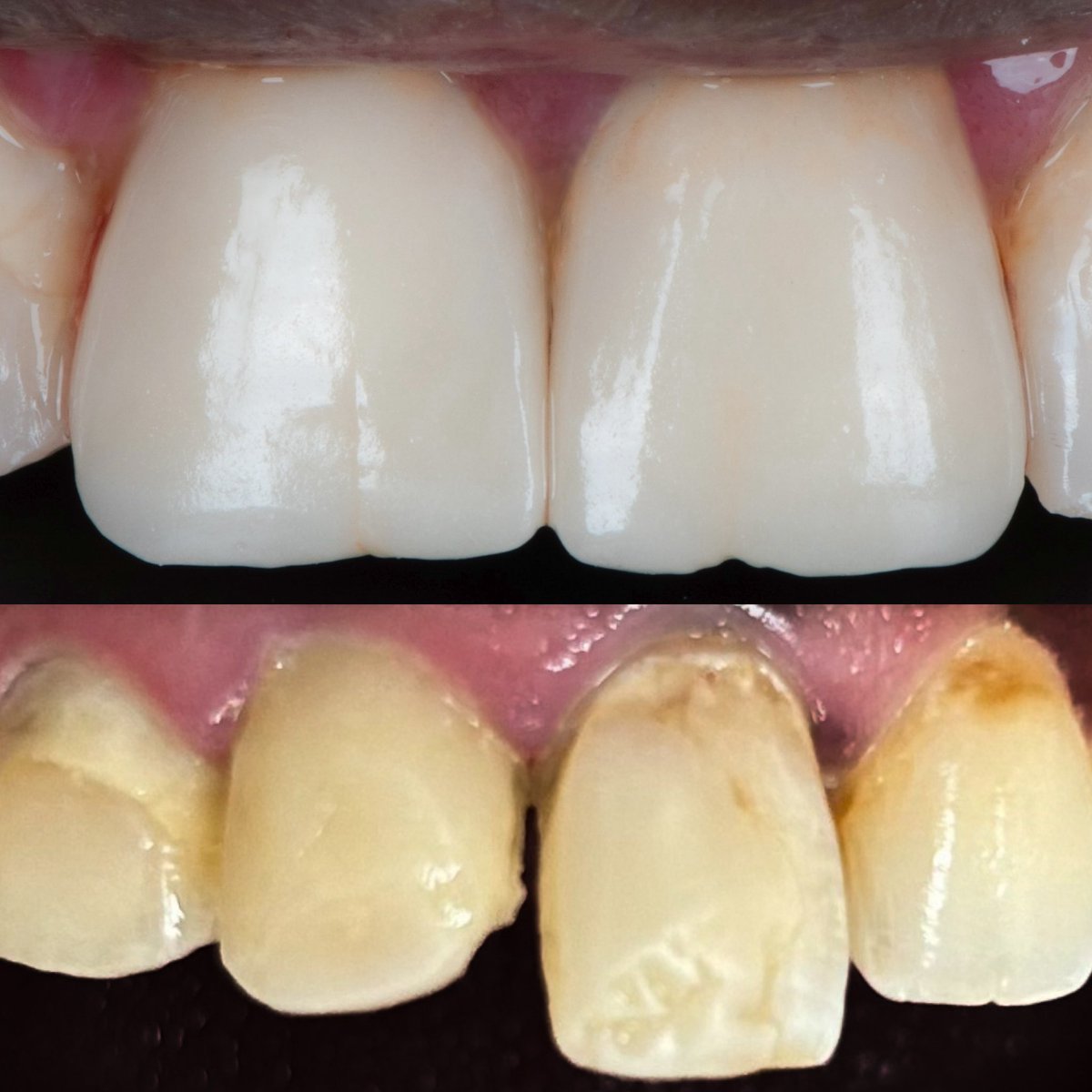 Majed_Dent's tweet photo. تلبيستين للسنين الأمامية العلوية ✅

PFM crowns on upper central incisors https://t.co/L3Iynj3AzA