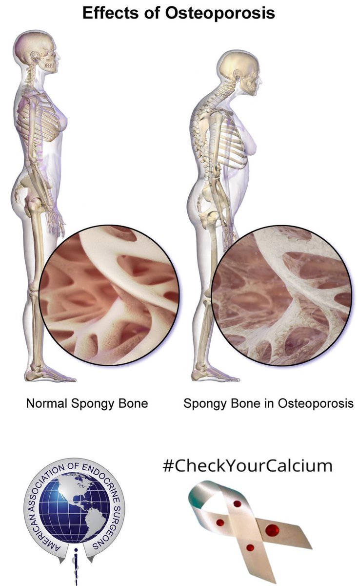 TheAAES's tweet image. Patients with hyperparathyroidism are at increased risk for bone loss and osteoporosis, particularly at the forearm, due to high parathyroid hormone levels drawing calcium out of the bone. #CheckYourCalcium #PAM2024 @TheAACE @ParaTroupers1 @TheEndoSociety
