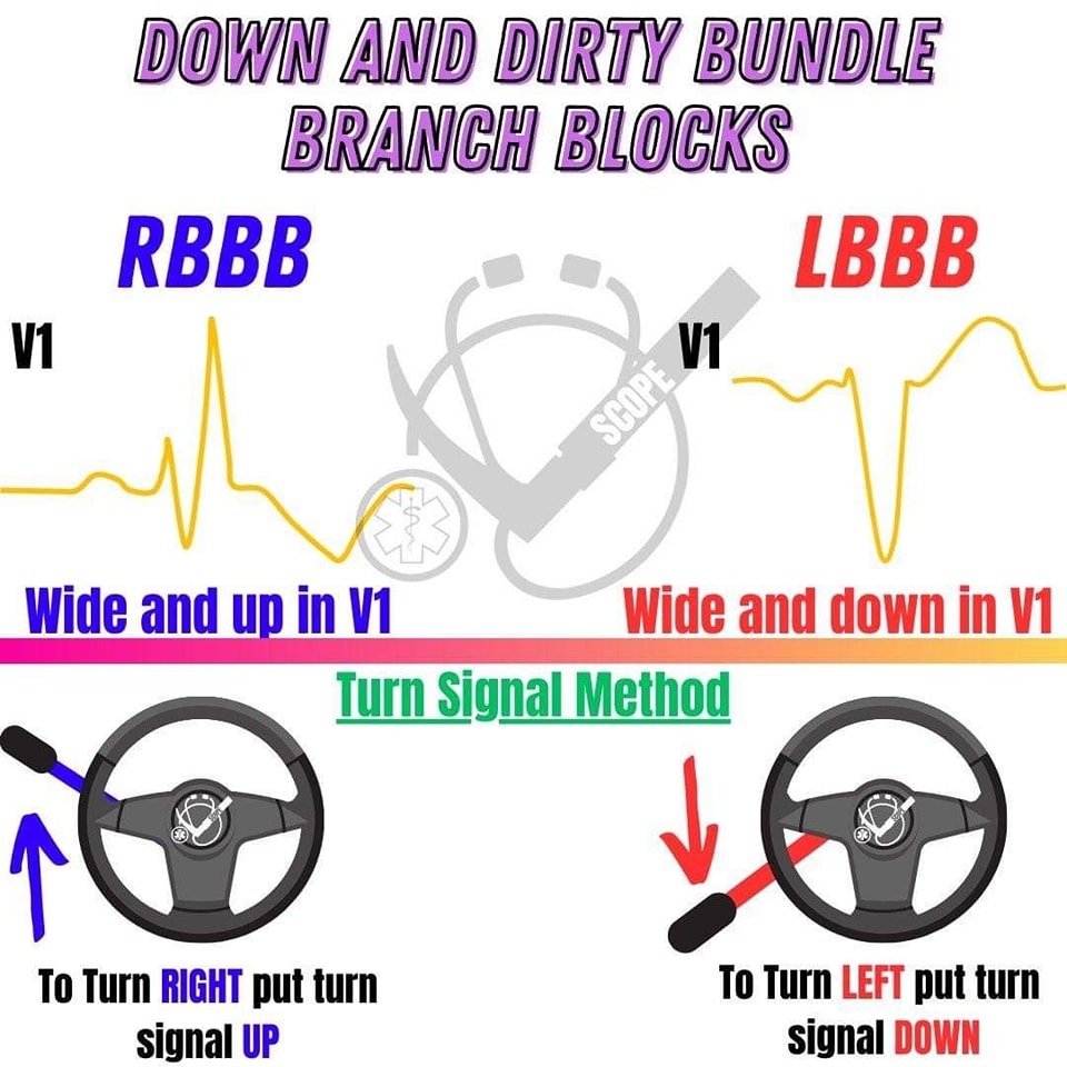 ZHeart11768530's tweet photo. 🔴 #ECG #LBBB #RBBB
🔷️ Difference between Left Bundle Branch Block(LBBB) and Right Bundle Branch Block(RBBB) . https://t.co/lm7CI91fA5
