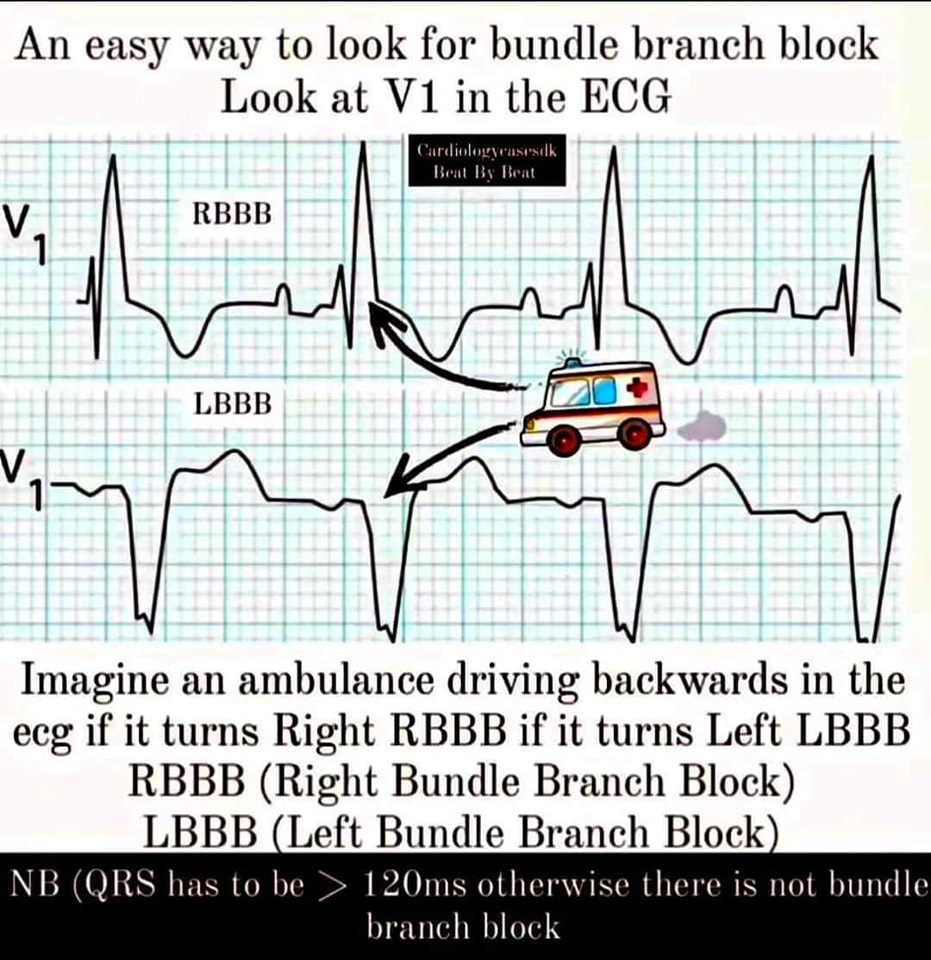 ZHeart11768530's tweet photo. 🔴 #ECG #LBBB #RBBB
🔷️ Difference between Left Bundle Branch Block(LBBB) and Right Bundle Branch Block(RBBB) . https://t.co/lm7CI91fA5