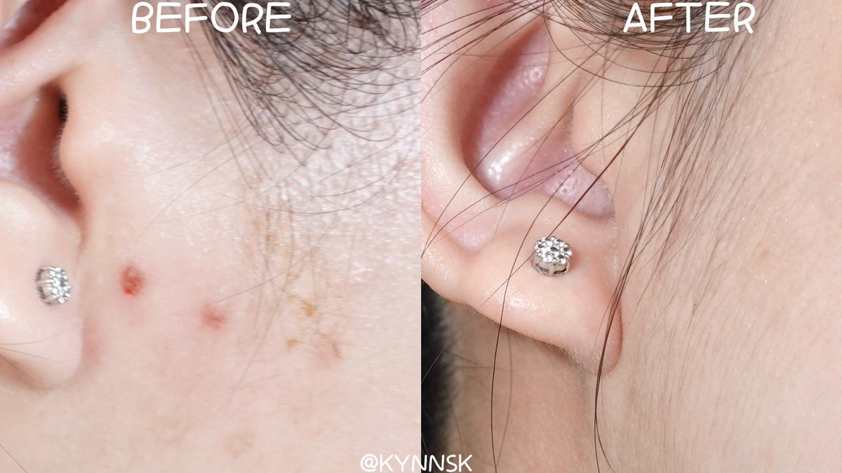 kynnsk's tweet photo. พลัง Eucerin สุดๆ เรื่องสิวหายไวแบบข้ามคืนไว้ใจเค้าได้เสมอ นี่คือปจดจะมา + ออกไปเจออากาศร้อนบ่อย สรุปสิวเห่อค่า 🥲 หยิบน้องคนนี้มาใช้ ก็สมชื่อ Eucerin SOS Serum ช่วยกู้ผิวได้ดีมากๆ สิวยุบไวแบบข้ามคืน ไม่ทิ้งรอยสิวไว้ด้วย ช่วยลดการอักเสบของผิว รักษาสิวแบบไม่ทำให้ผิวแห้งลอก เนื้อเบาสบาย ซึมไว ไม่เหนอะหนอะ เริ่ด! #EucerinThailand #EucerinSOSserum #EucerinSOSserumจัดการสิวเร่งด่วนใน8ชม