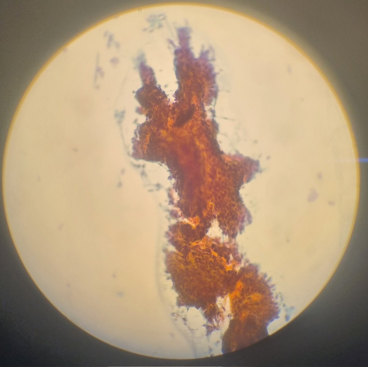 🏥 <a href="/TorrecardenasHU/">Hospital Universitario Torrecárdenas</a>

🫁UGC Neumología

👴79 años

🦀Colon ADK  T3cN1M0

🩻Nódulo pulmonar solitario 8mm

🔍Minisonda Radial

🔦Ambu aScope 5 Broncho 4.2/2.2 

❄️Criosonda 1.1mm Erbe

🔬➕️🦀 Impronta citológica positiva <a href="/bedi_begui/">Beatriz Agredano</a> <a href="/patiloleta/">LOLETA BF</a>