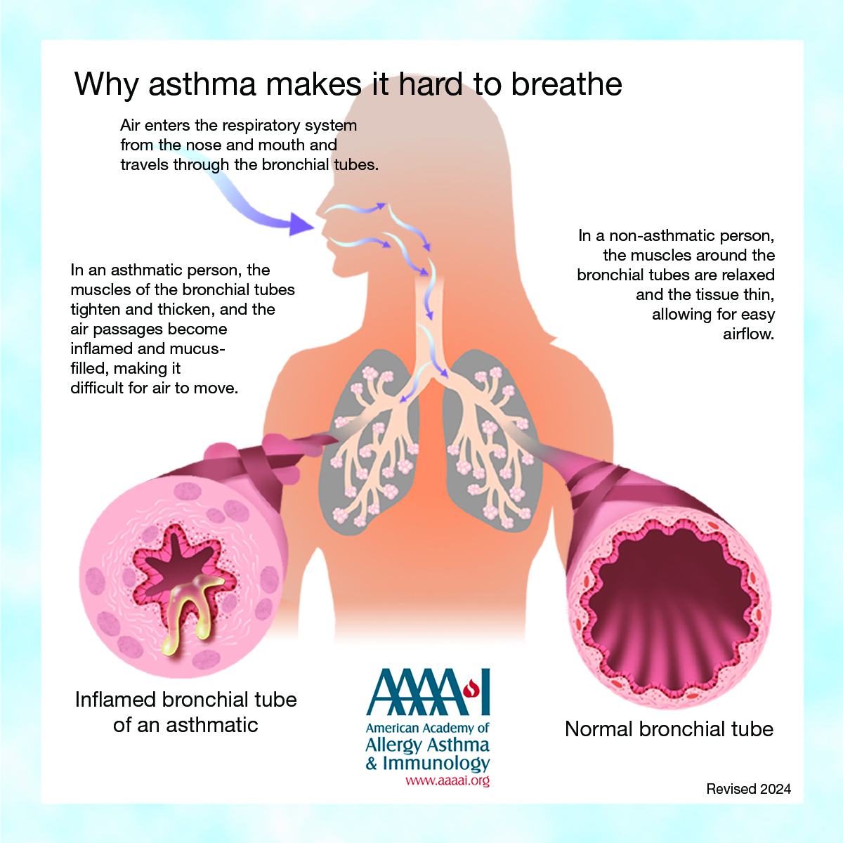 #asthma