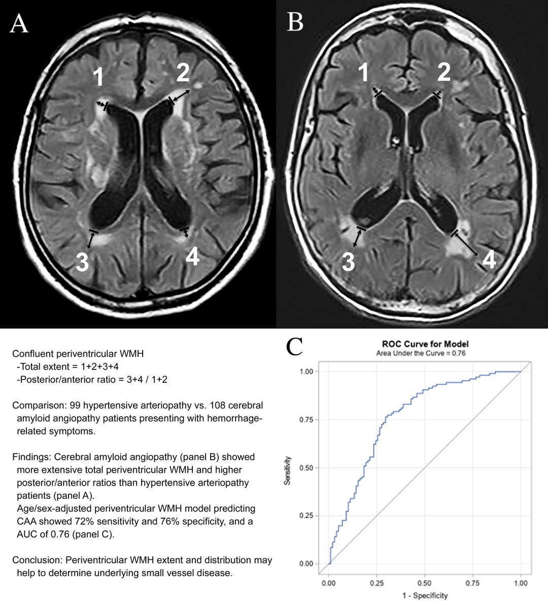 🧵#STROKE: In a retrospective observational cohort study, severe posterior periventricular white matter hyperintensities (PWMH) and high posterior/anterior PWMH ratio on FLAIR MRI were associated with probable cerebral amyloid angiopathy as opposed to hypertensive angiopathy.