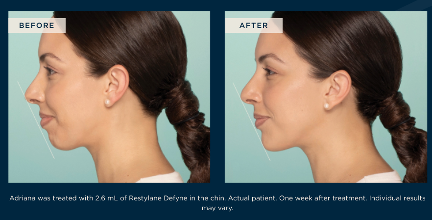 SmoothSynergy's tweet image. If your skin seems to be sliding south, we have the answer. Here’s all you need to know about Fillers for Jowls – a terrific nonsurgical option that restores the lower face to the contoured, lifted and smooth appearance of youth. smoothsynergy.com/fillers-for-jo…