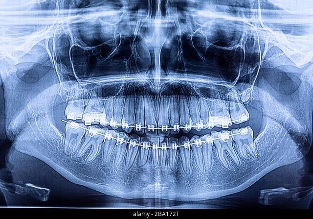 JohnFlutter's tweet image. Here are 4 potentially life-long problems with braces that everybody should be aware of: