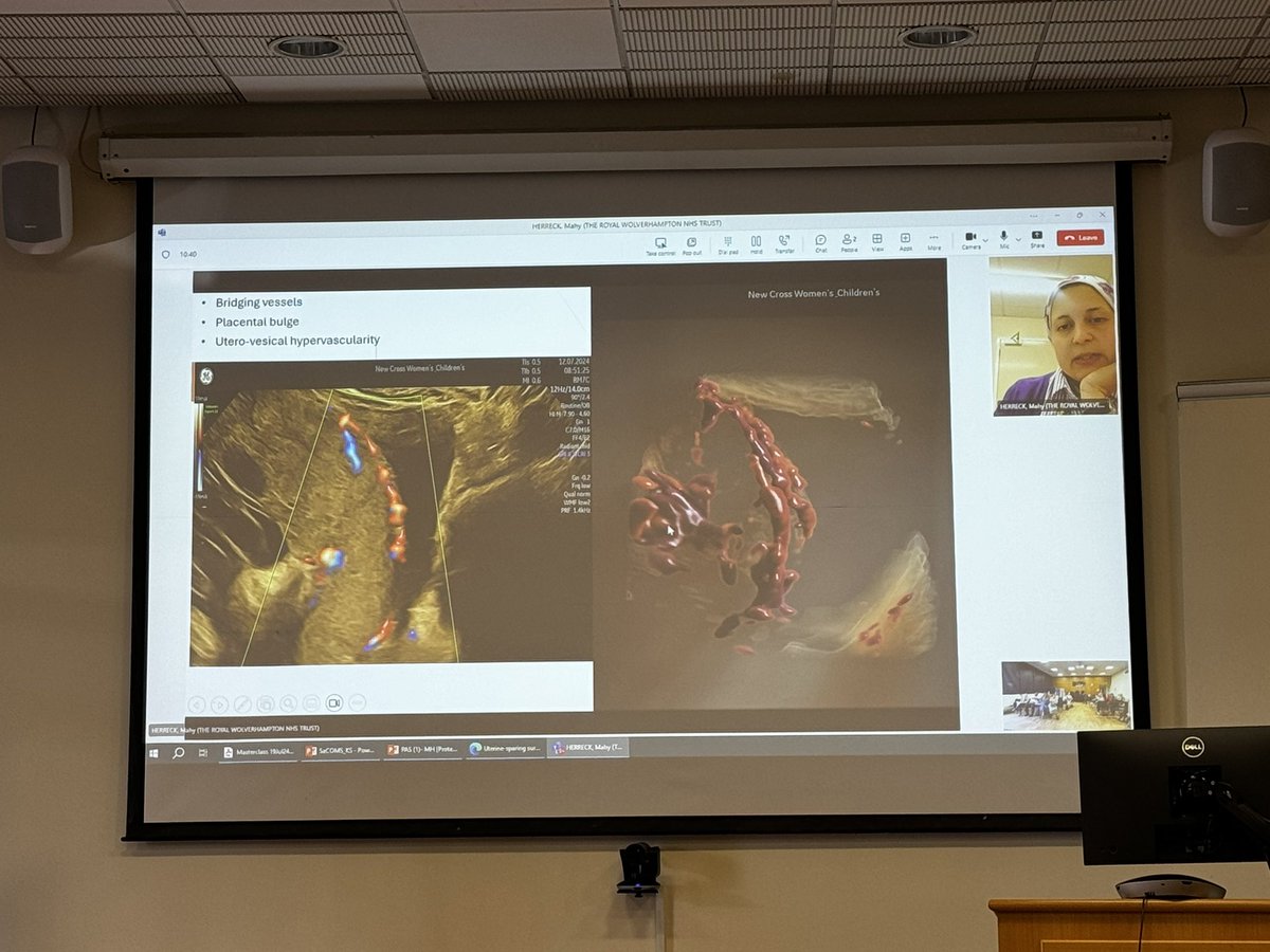 Today was a brilliant masterclass for the Westmidlands trainees exploring complex CS. Time for better-structured training in complex obstetrics <a href="/RCObsGyn/">RoyalCollegeObsGyn</a> <a href="/RWT_NHS/">The Royal Wolverhampton NHS Trust 🏥</a> #placenta_accreta #medical_education