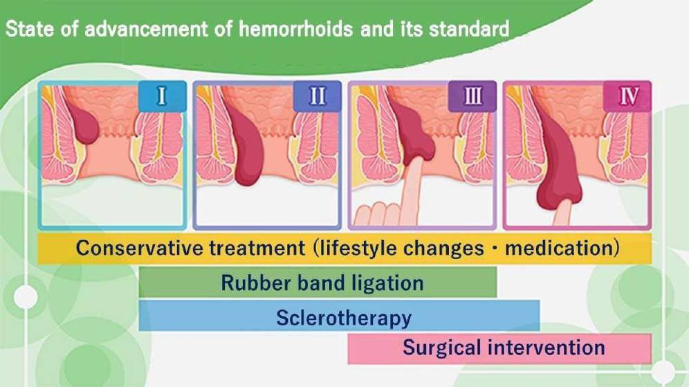 SMLE_NA's tweet photo. Explanation:

Patients with grade II or III internal hemorrhoids are the best candidates for rubber band ligation. https://t.co/HqJIwEd0tG